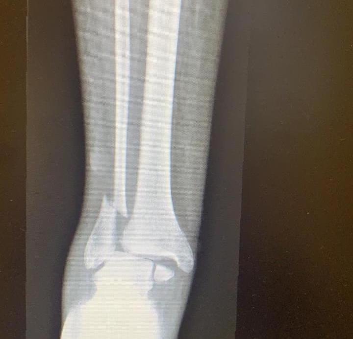 broken bone